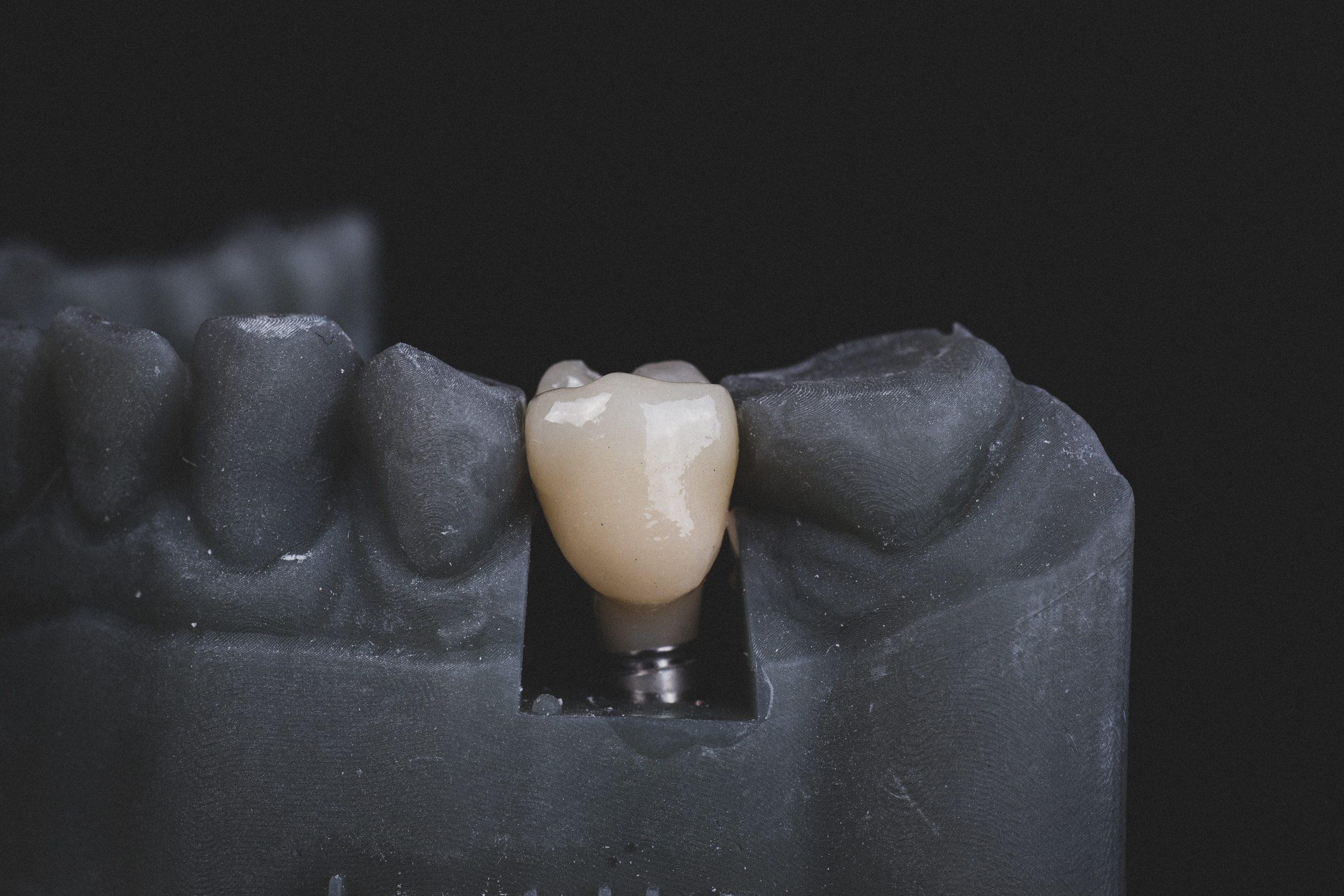 Why Dental Implants Are the Best Solution for Missing Teeth: Insights from Your Dentist in Fowler IN
