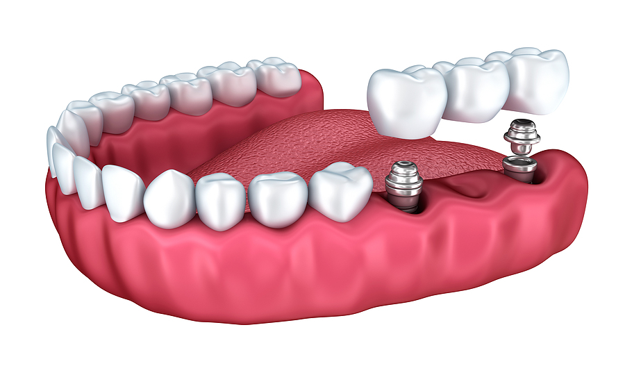 Reclaim Your Smile with Dental Implants in Fowler IN
