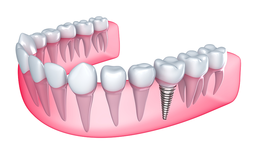 Restore Your Smile with Durable and Natural-Looking Dental Implants in Fowler IN