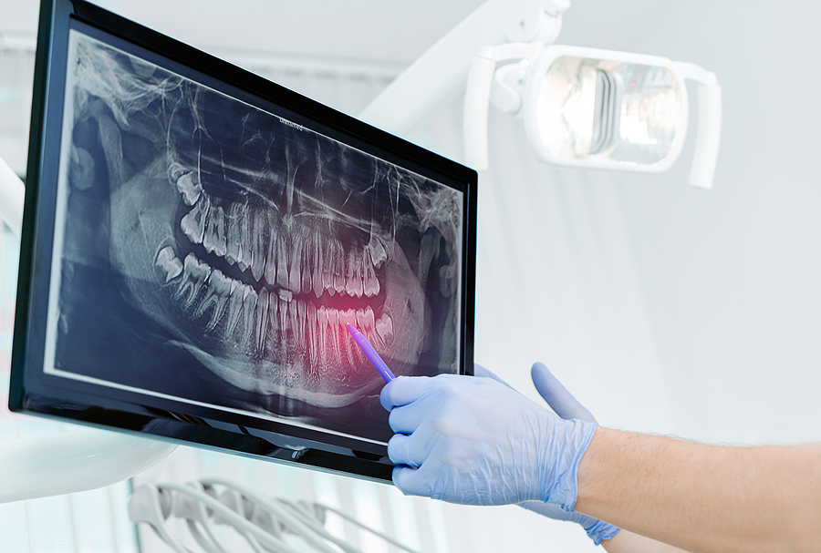 The Advantages of Digital X-Rays in Modern Dentistry