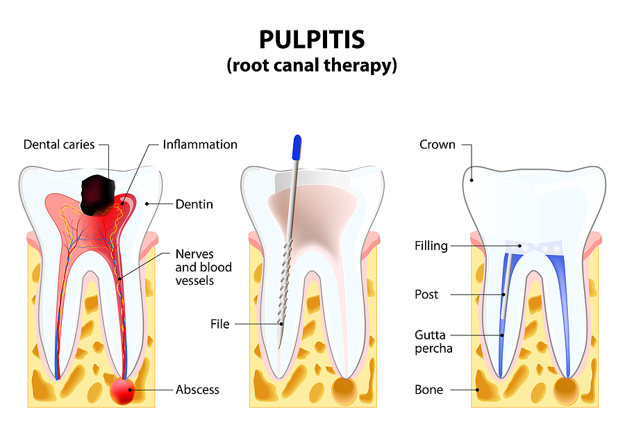 Understanding Root Canal Therapy: A Guide to Saving Your Teeth